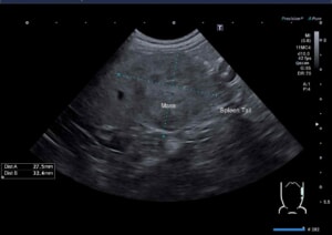 トイプードル　脾臓腫瘤　エコー