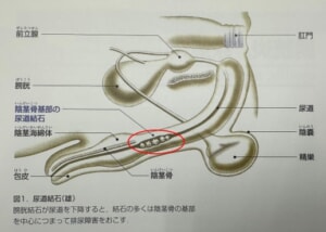 犬尿道結石　イメージ図