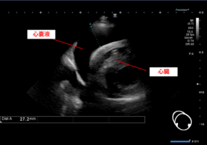 心タンポナーデ　エコー