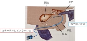 カテーテルフラッシュ