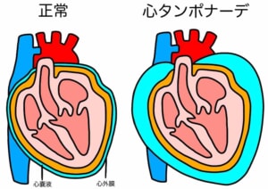 心タンポナーデ　イメージ図